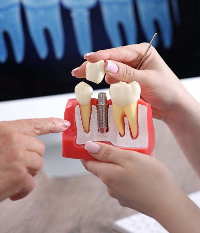 Dental implant model shown to a patient