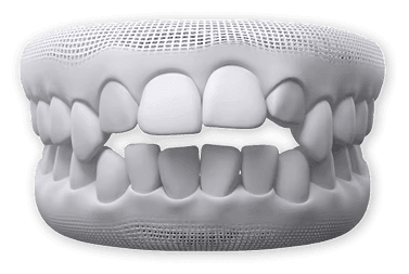Open Bite Teeth